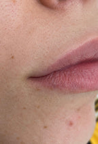 Upper Lip Laser Hair Removal