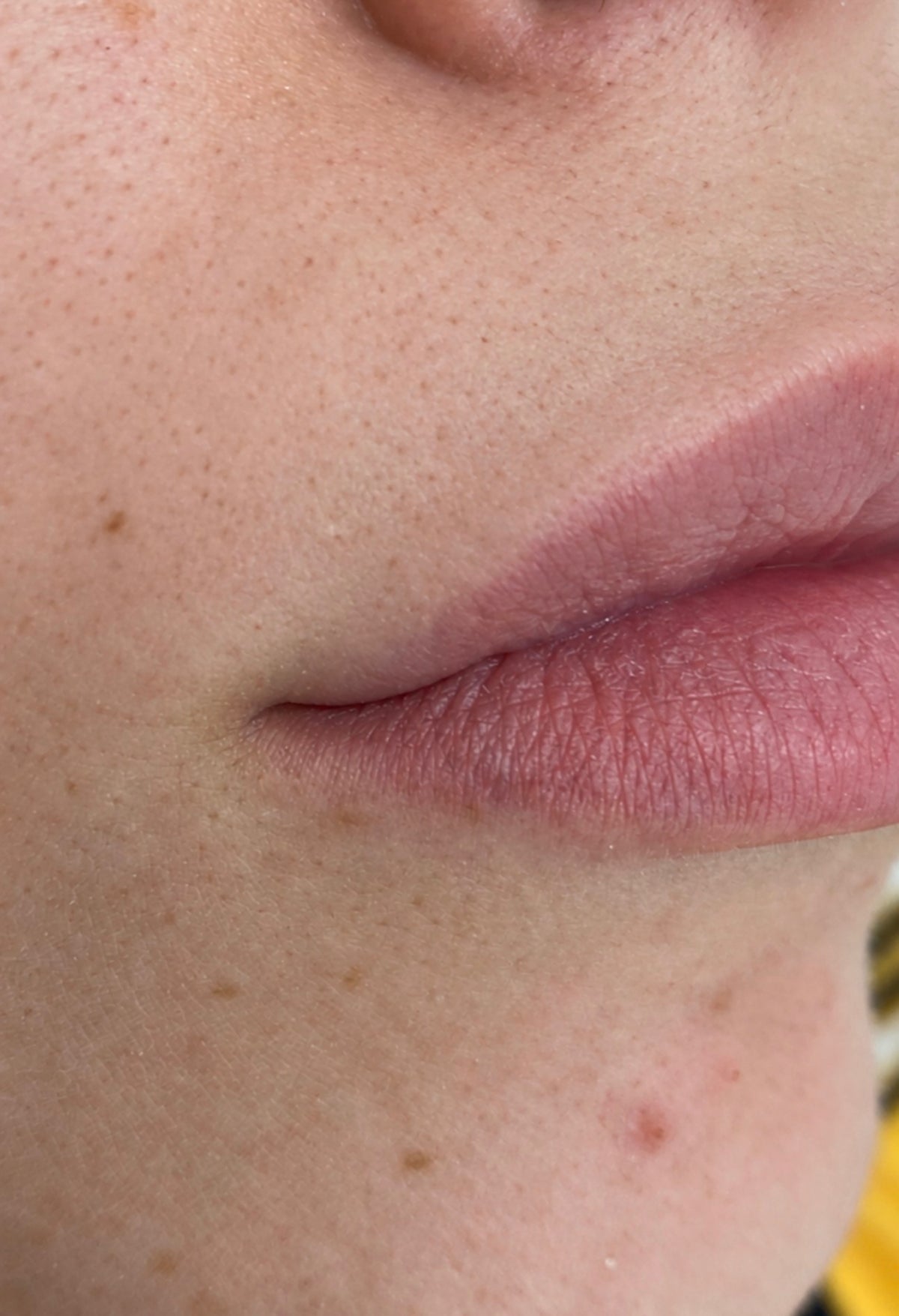 Upper Lip Laser Hair Removal