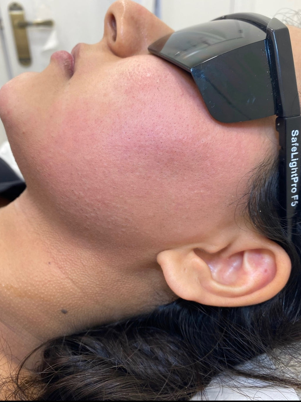 Sideburns Laser Hair Removal