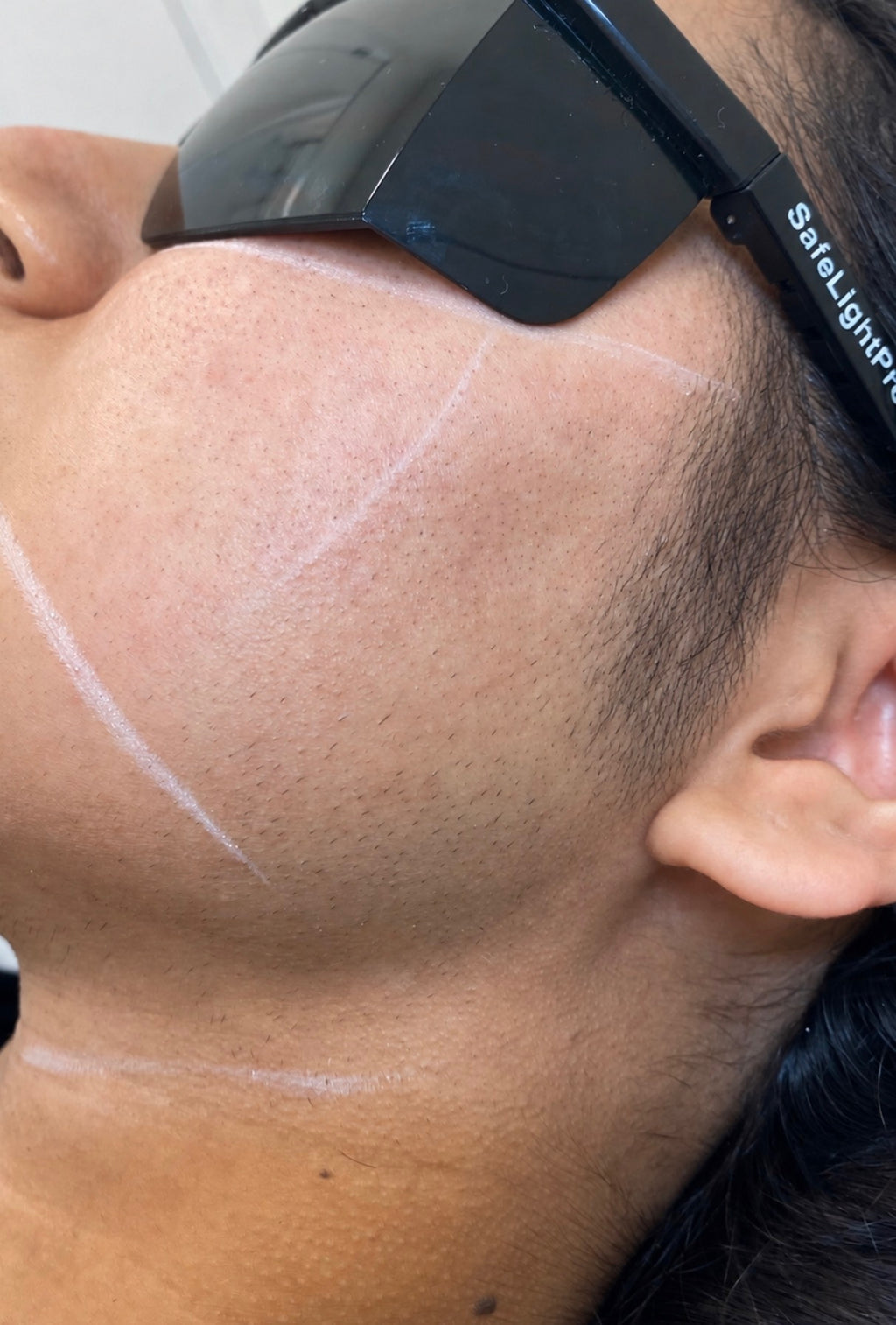 Sideburns Laser Hair Removal