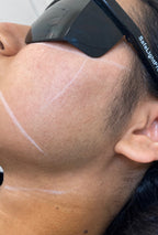 Sideburns Laser Hair Removal