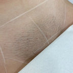 Bikini Line Laser Hair Removal