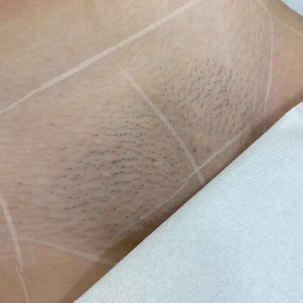 Bikini Line Laser Hair Removal