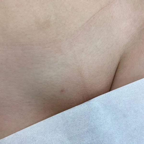 Bikini Line Laser Hair Removal