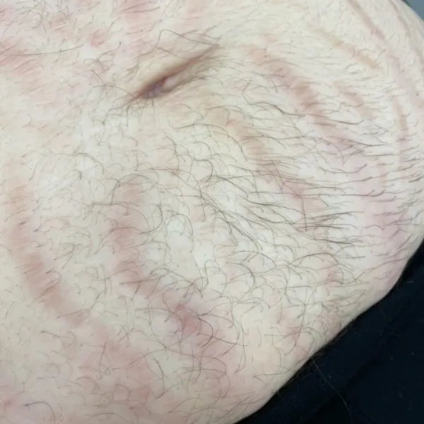 Full Stomach Laser Hair Removal