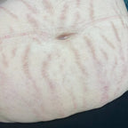 Full Stomach Laser Hair Removal