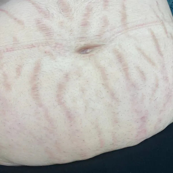 Full Stomach Laser Hair Removal