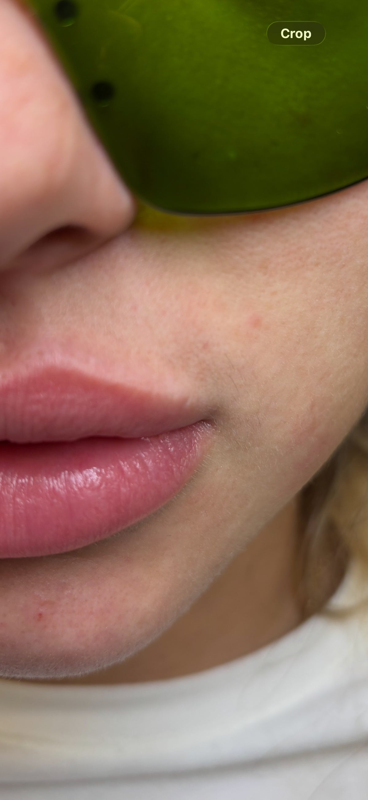 Upper Lip Laser Hair Removal