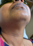 Lower Face Laser Hair Removal