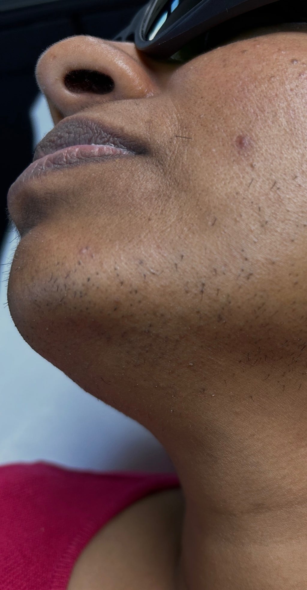 Lower Face Laser Hair Removal