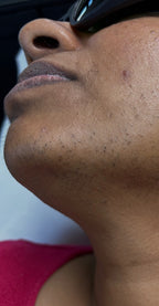 Lower Face Laser Hair Removal