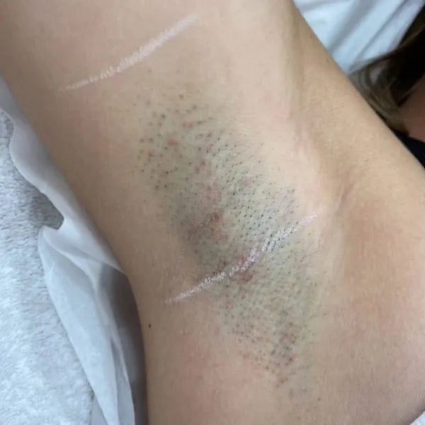 Underarm Laser Hair Removal
