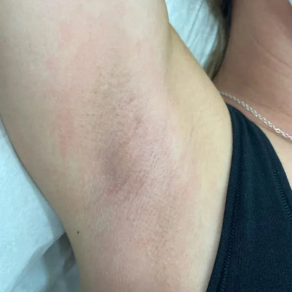 Underarm Laser Hair Removal