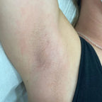 Underarm Laser Hair Removal
