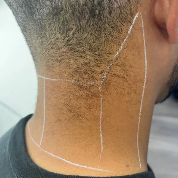 Neck Shaping Laser Hair Removal