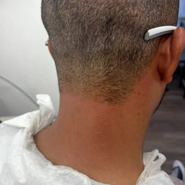 Neck Shaping Laser Hair Removal
