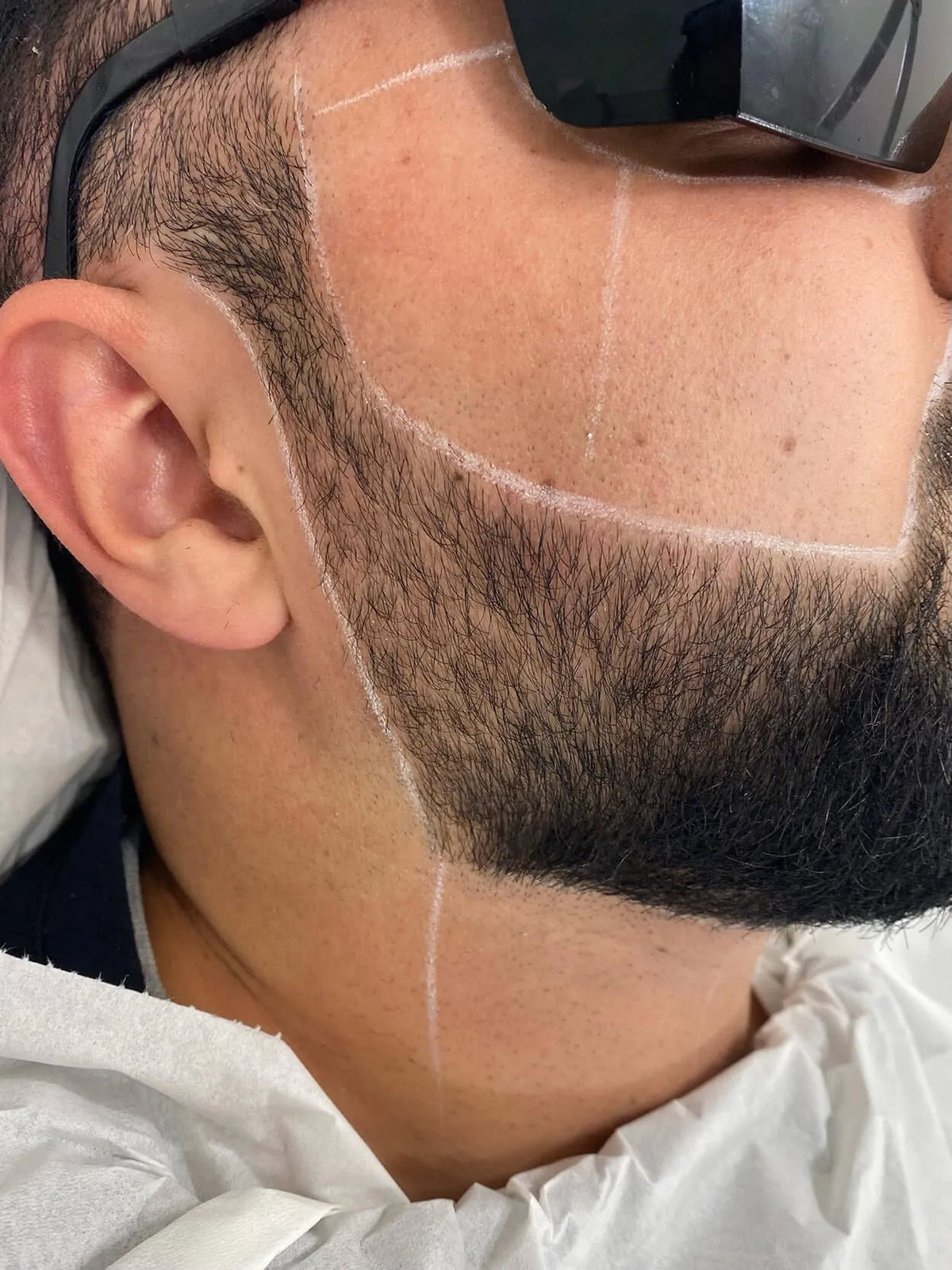 Beard Shaping Laser Hair Removal