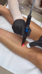 Lower Leg Laser Hair Removal