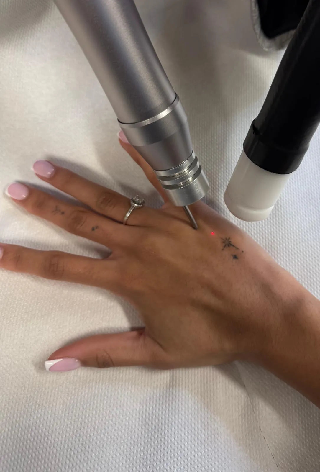 Hand, Neck & Face Laser Tattoo Removal