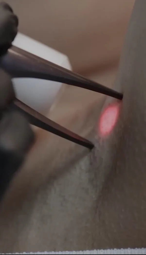 Underarm Laser Hair Removal