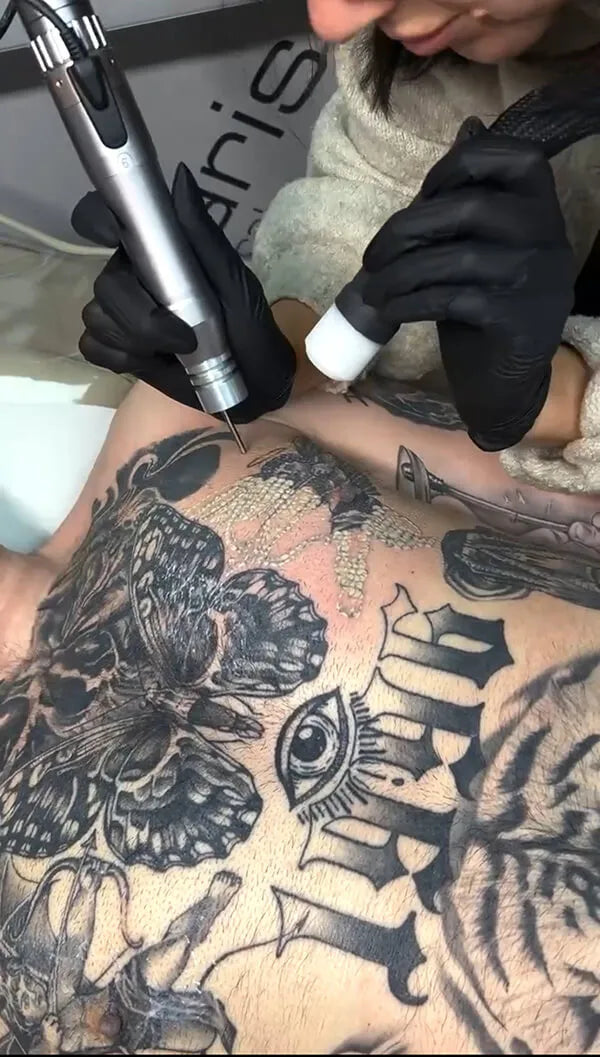 Body Laser Tattoo Removal